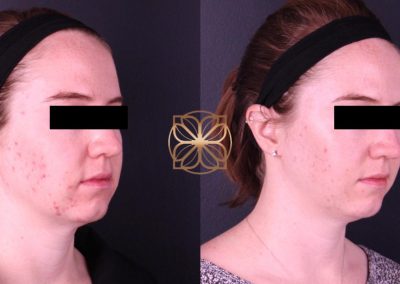 Diamond Glow 3 Months After Spa26 Beverly Hills