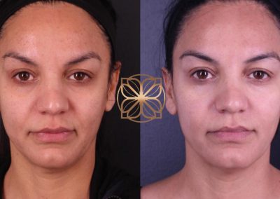 Morpheus, Diamond Glow, Filler to Tear Troughs, NLF, Marionettes, & Botox Spa26 Beverly Hills