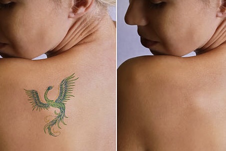 Tattoo Removal Aftercare And Recovery