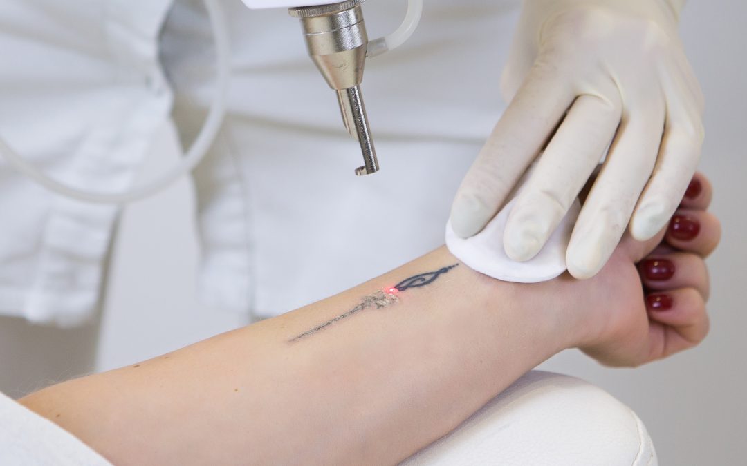 PicoSure Tattoo Removal Beverly Hills