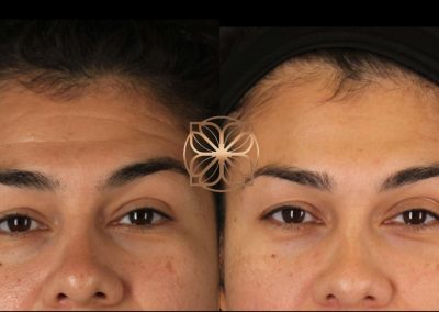 Botox for Forehead Spa26 Beverly Hills