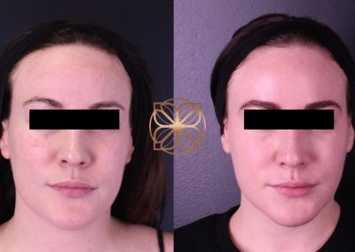 Facetite & Gold Tip Facial 2.5 Month Post Op Spa26 Beverly Hills