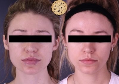 Flawless Facial Before and After 2