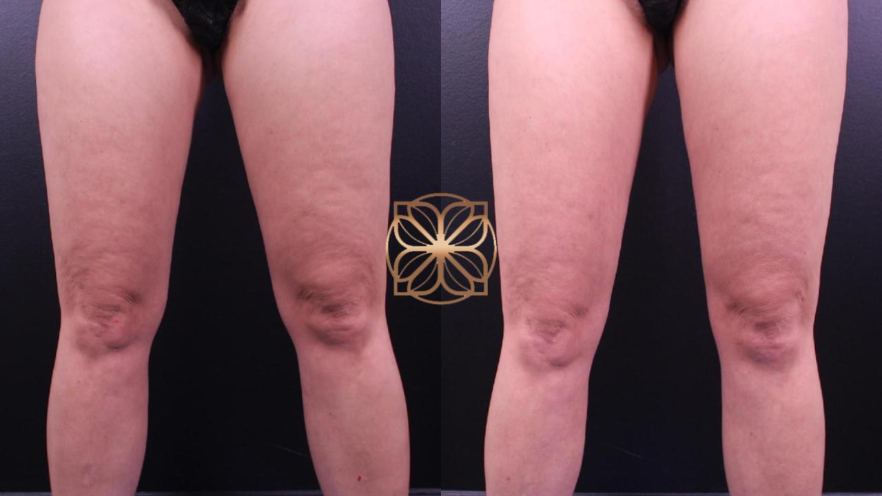 Liposuction, Bodytite, &Amp; Morpheus Knees After 1 Month Spa26 Beverly Hills
