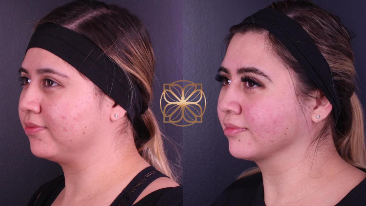Spa26 B&a Bfpr And Facetite 4 Months Post Op.pptx (1)