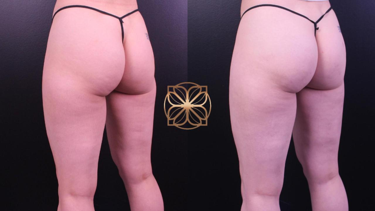 Spa26 B&a Cellfina And Liposuction Outer Thighs 3 Months Post Op.pptx (1)