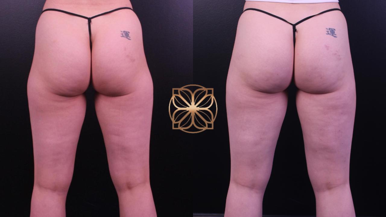 Spa26 B&a Cellfina And Liposuction Outer Thighs 3 Months Post Op.pptx (2)