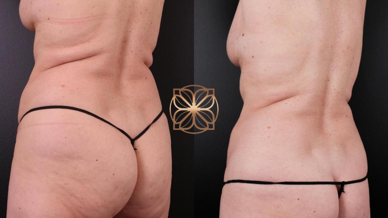 Spa26 B&a Coolsculpting Front And Back 2 Months B&a.pptx (1)