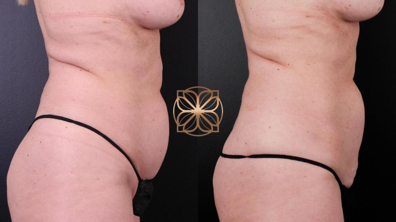 Spa26 B&a Coolsculpting Front And Back 2 Months B&a.pptx (2)