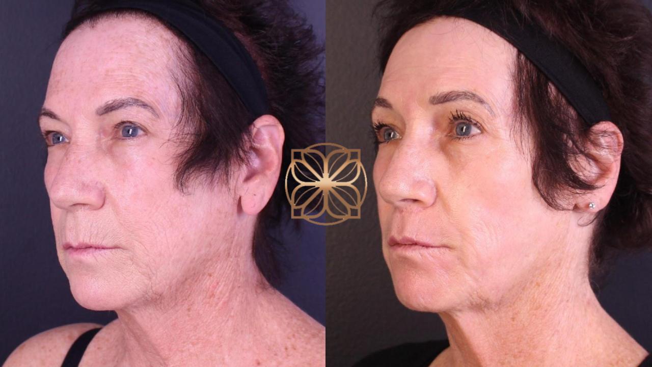 Spa26 Before After Facetite 5 Months Post Op.pptx 1