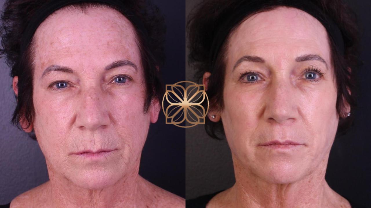 Spa26 Before & After Facetite 5 Months Post Op