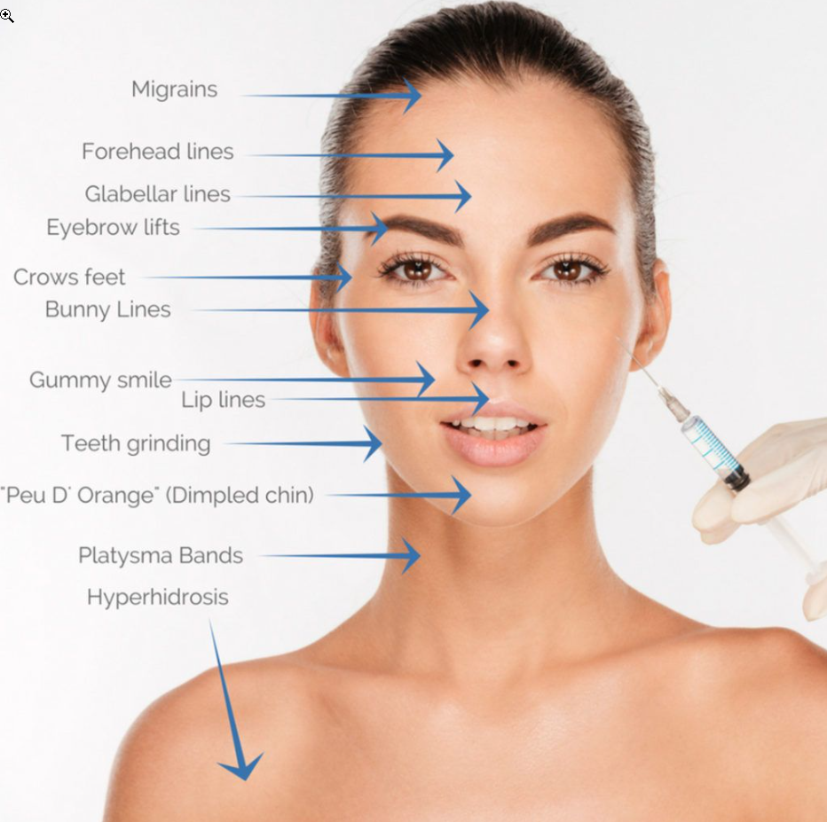 Injectable Wrinkle Relaxers Treatment Areas
