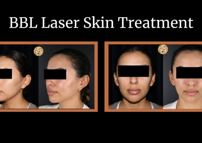BBL Laser skin treatment before and after