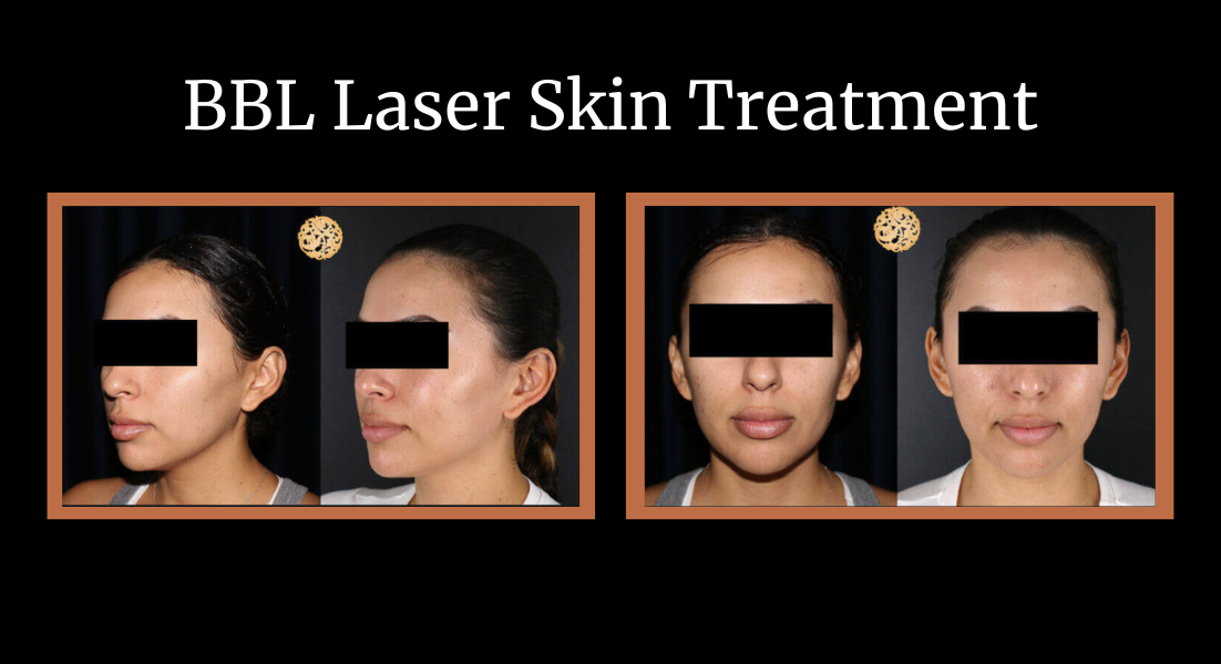 BBL Laser skin treatment before and after