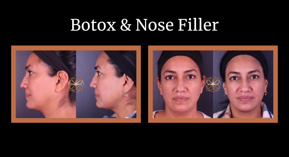 Botox and nose filler before and after