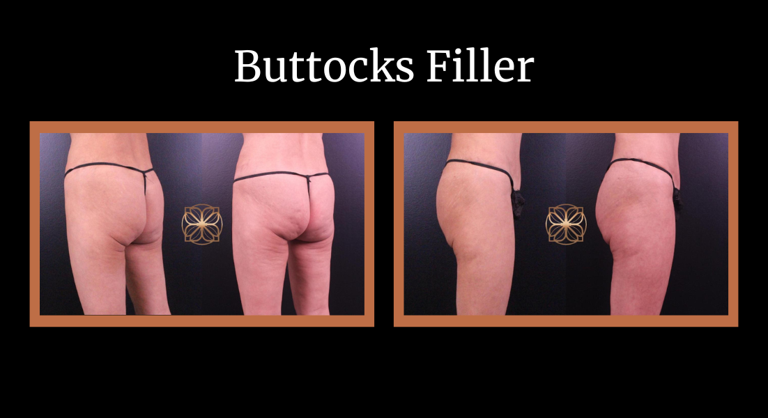 Buttocks Filler before and after