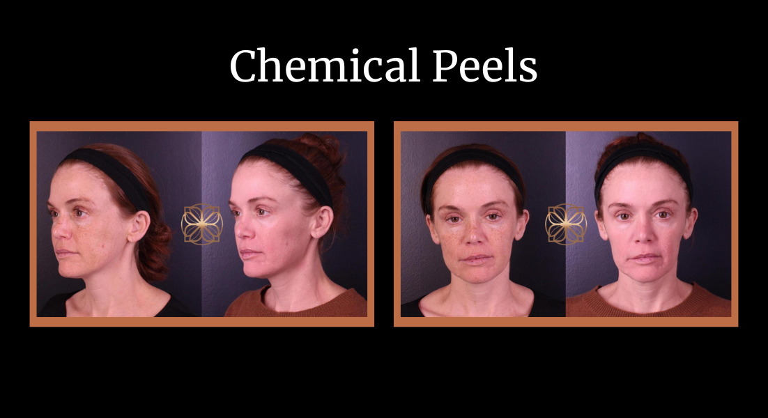 Chemical peels before and after