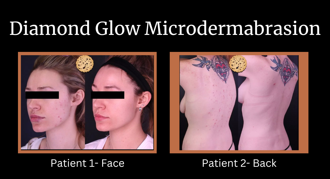 Diamond Glow Microdermabrasion before and after