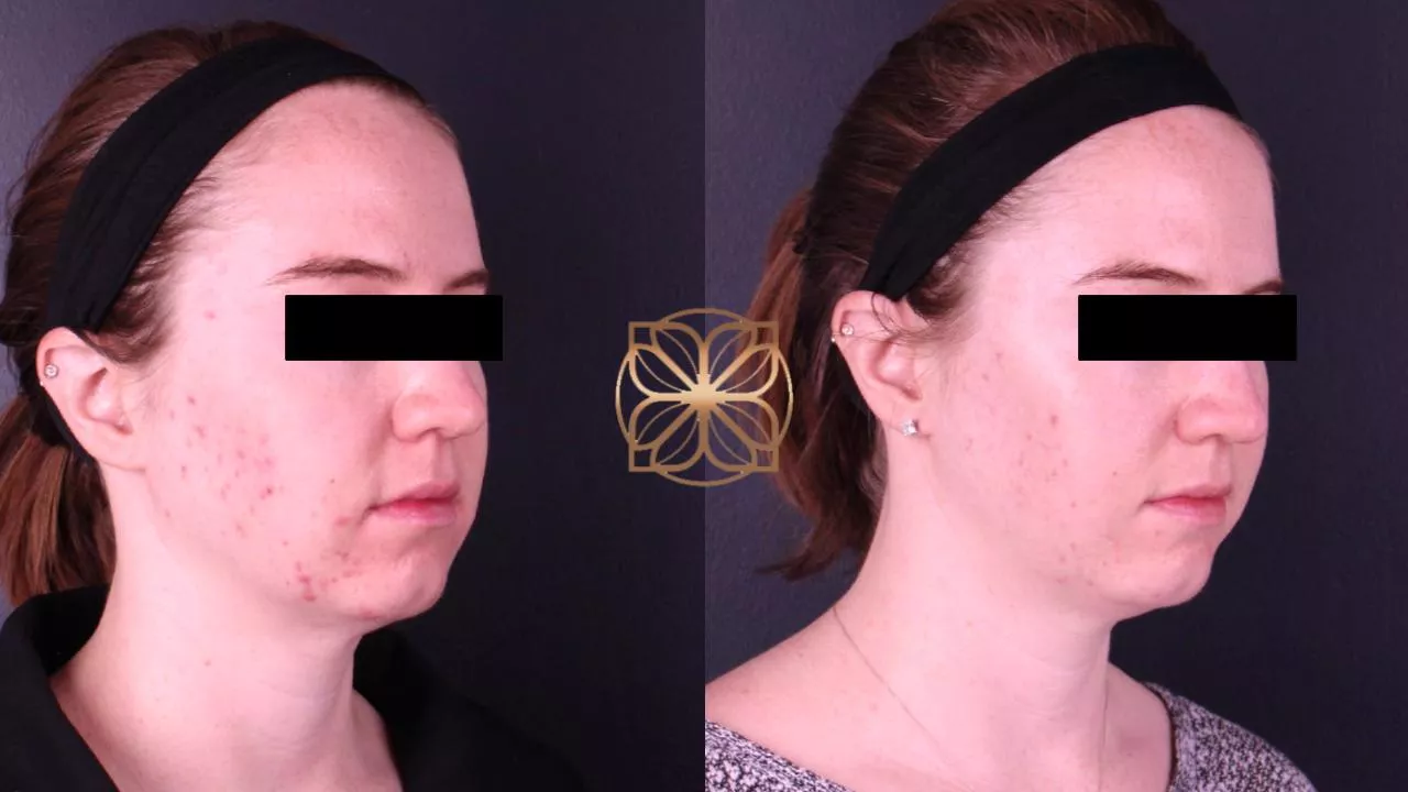 Diamond Glow Microdermabrasion before and after