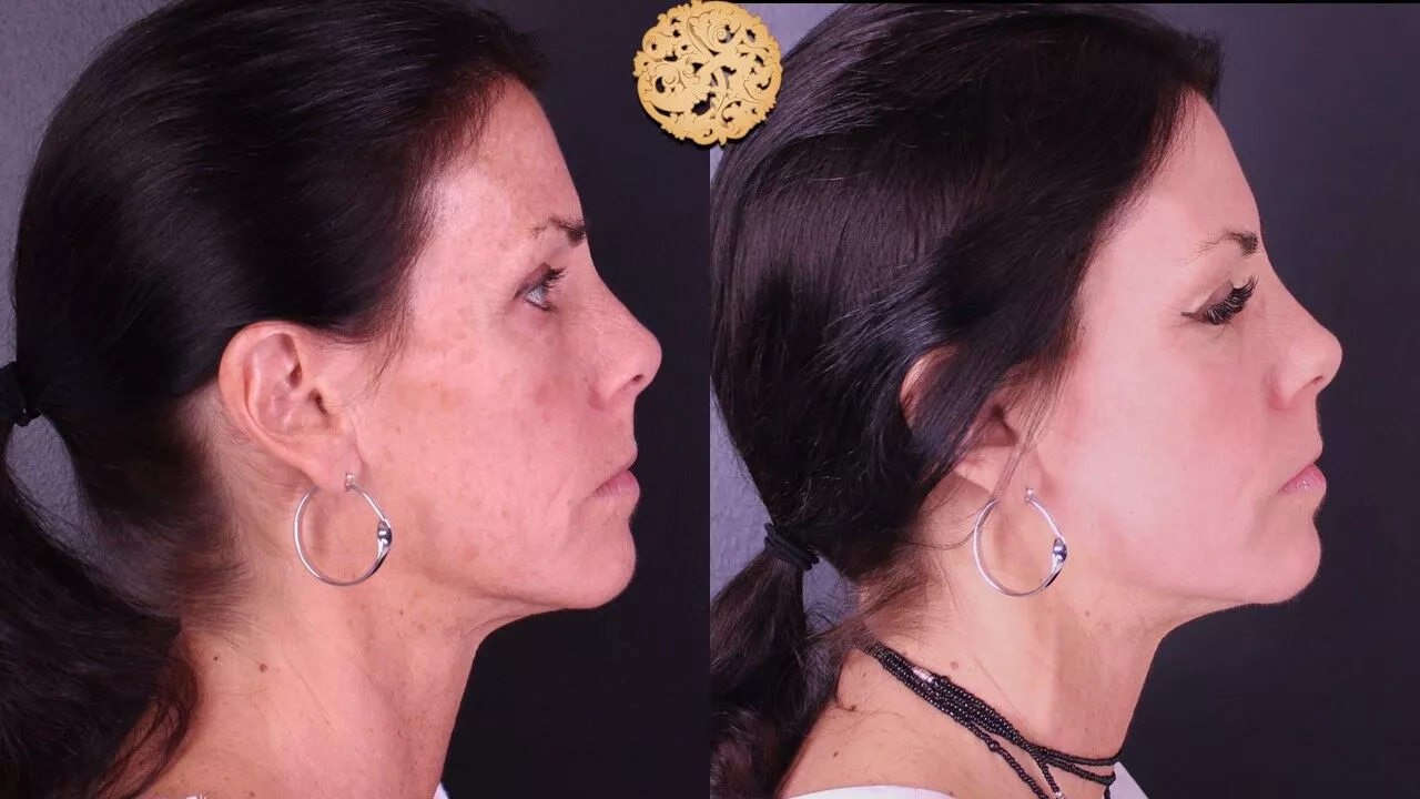 Erbium Contour TRL Resurfacing before and after