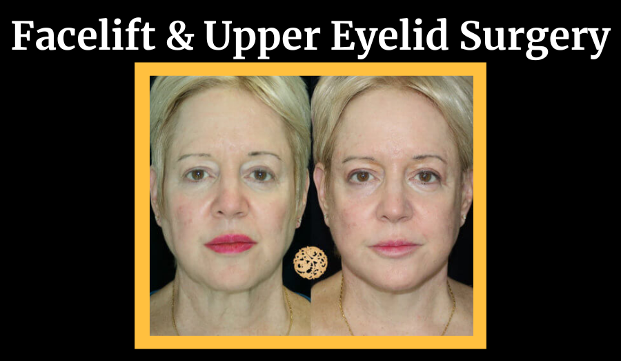 Facelift and Upper Eyelid Surgery