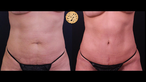 Fleur-De-Lis Tummy Tuck before and after