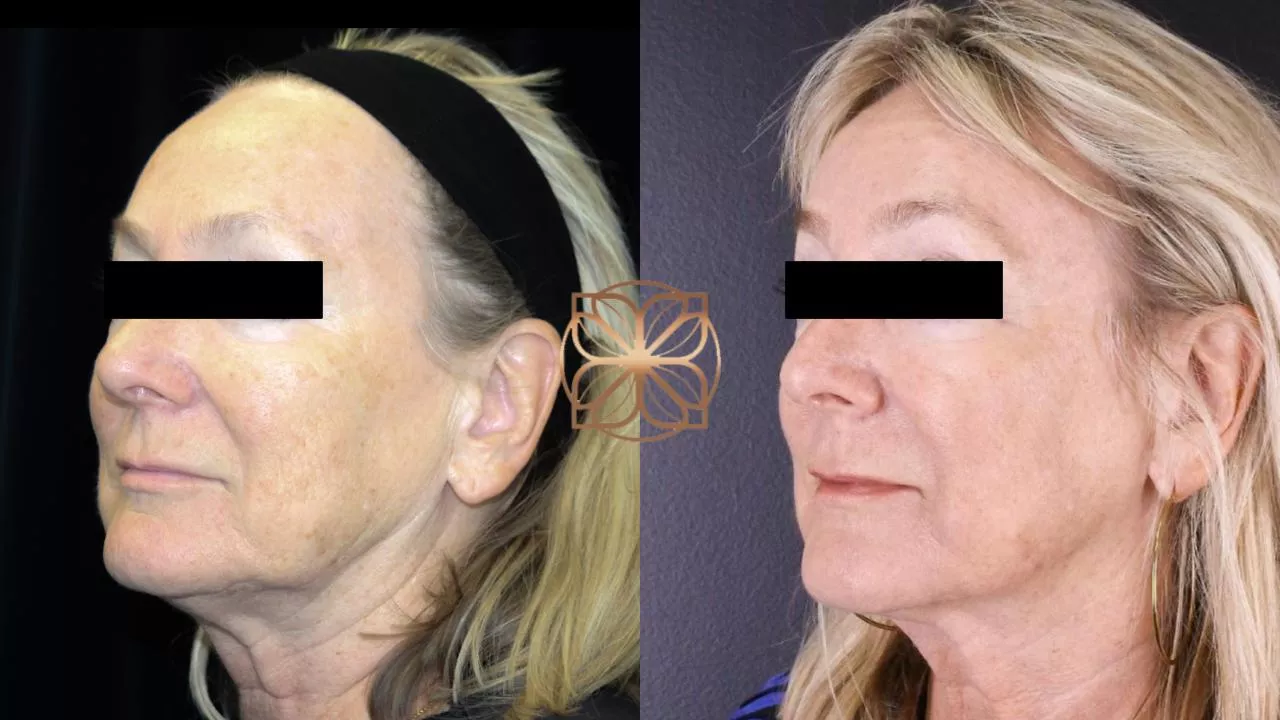 Halo Fractional Laser Resurfacing before and after