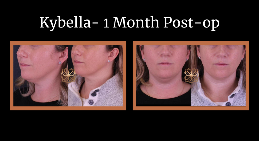 Kybella 1 Month post-op before and after