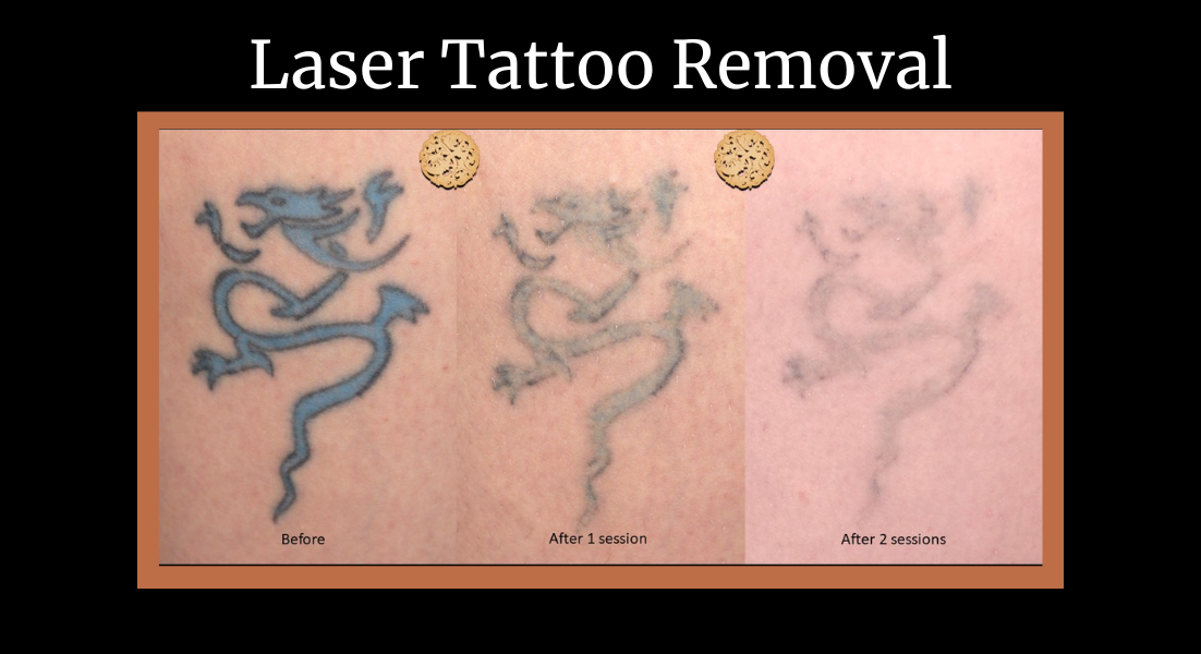 Laser tattoo removal before and after