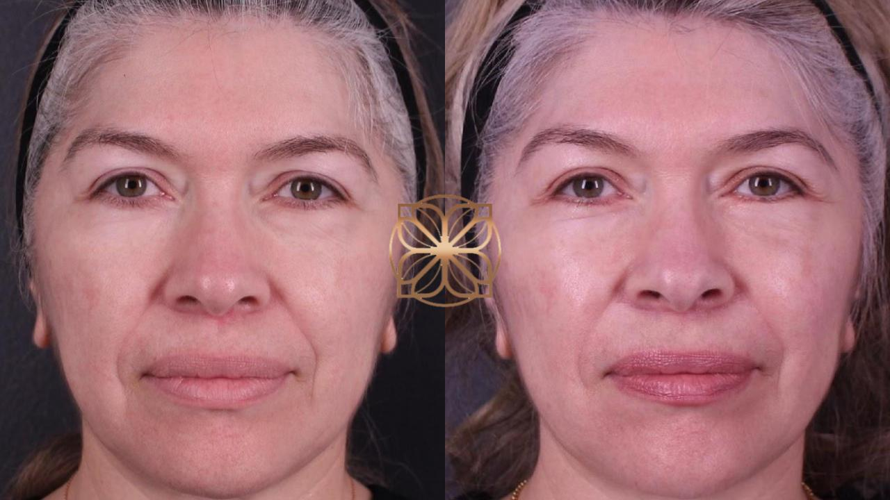 Lower Eyelid Blepharoplasty before and after