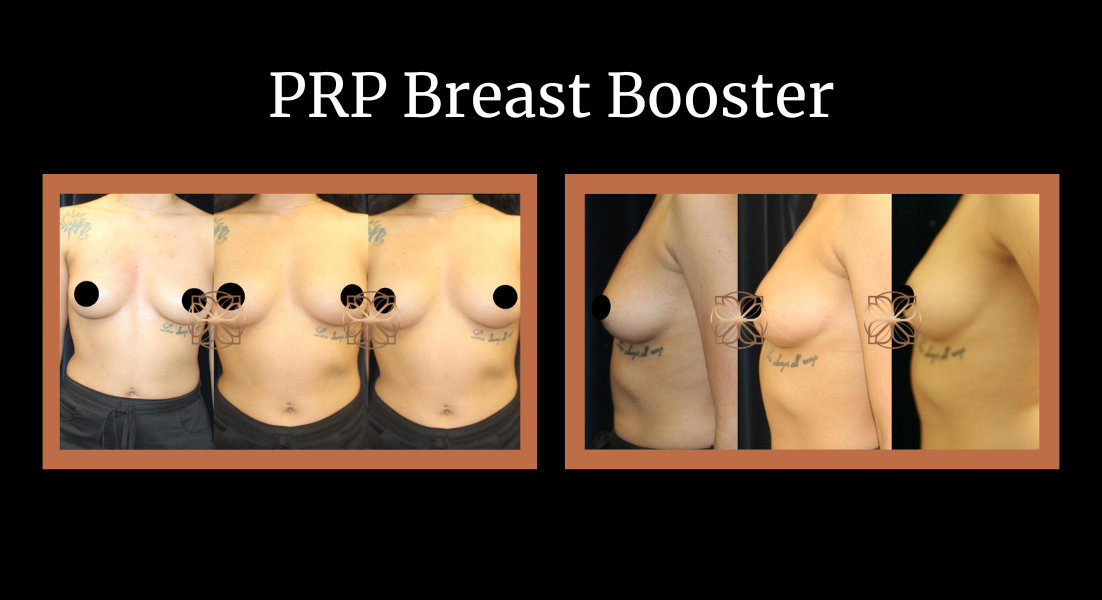 PRP Breast Booster before and after