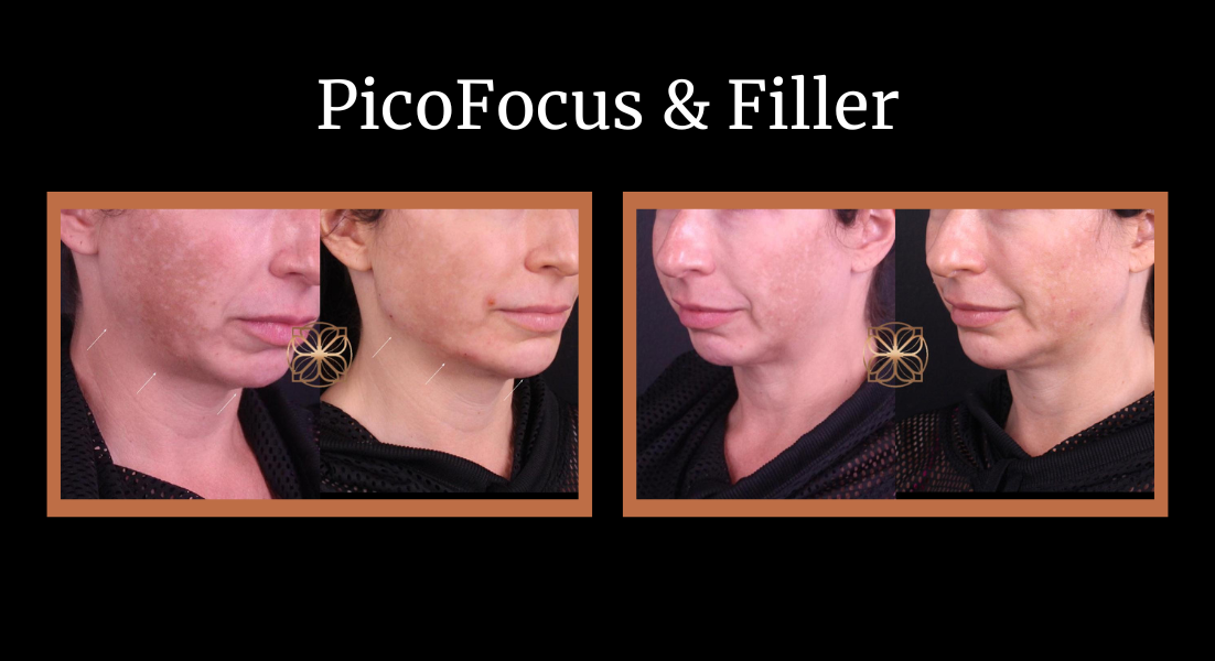 Picofocus and filler before and after