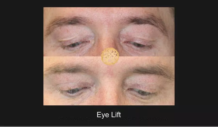 Upper Eyelid Blepharoplasty before and after male patient