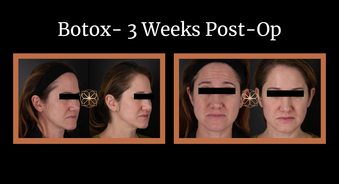 botox 3 weeks post-op before and after