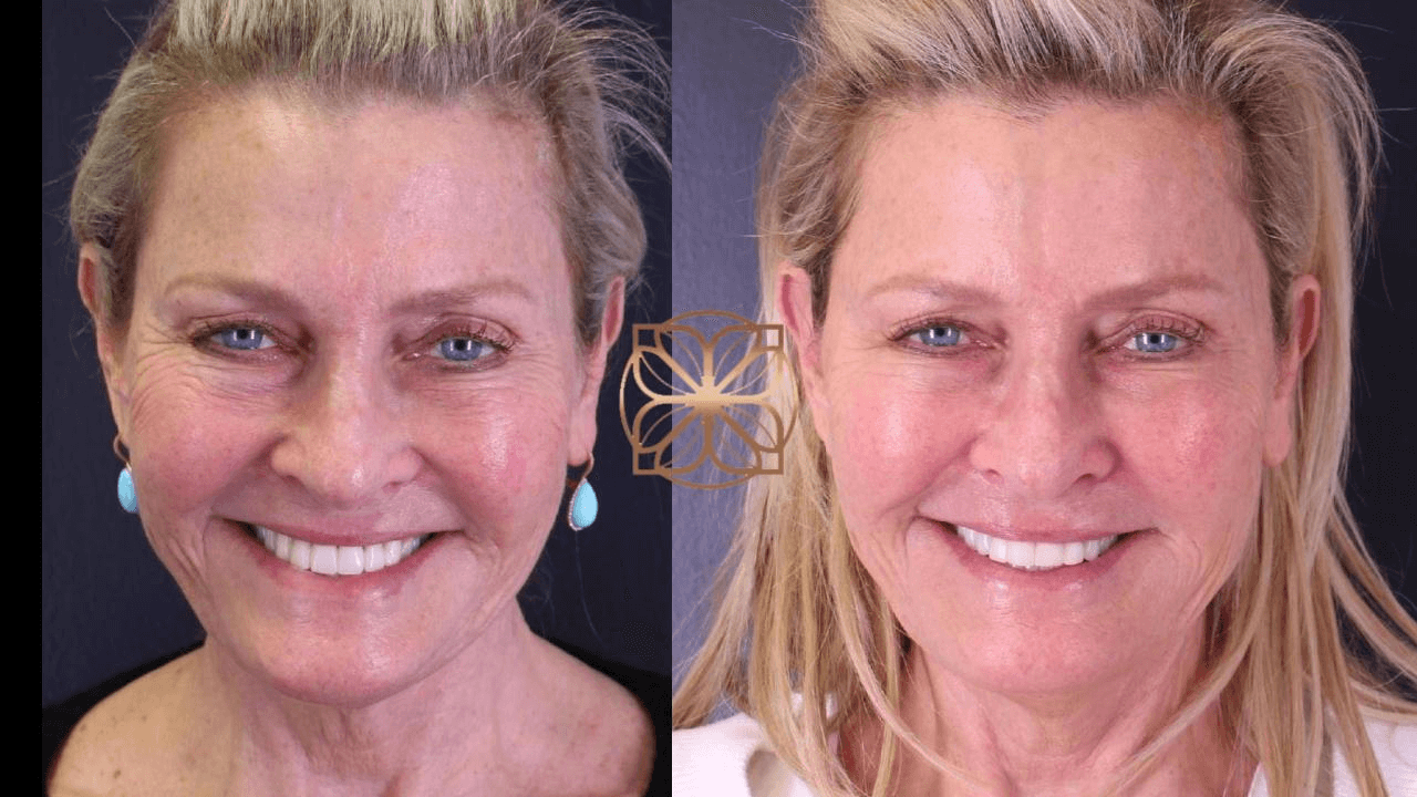 Female patient Dermal fillers before and after photo 2