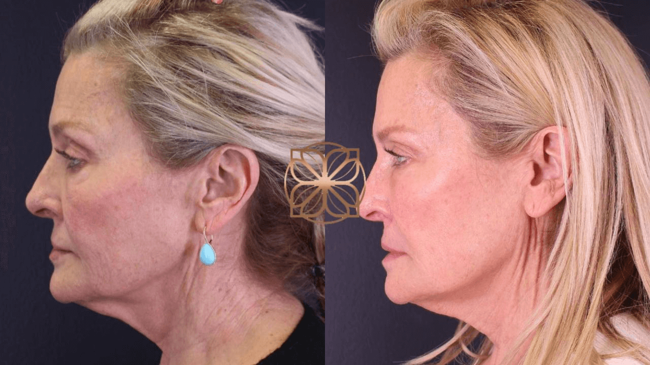 Female Patient Dermal fillers before and after photo