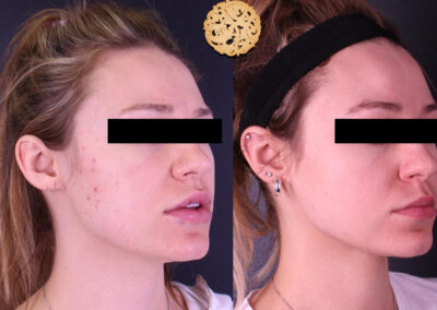 Female face before and after dermaplaning treatment, showing acne reduction and skin clarity.