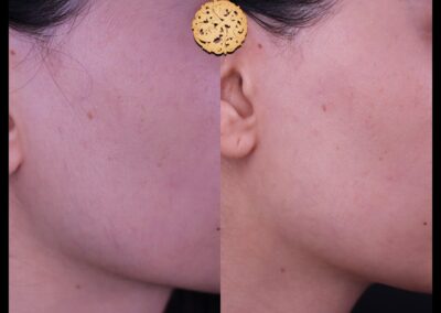 Side-by-side comparison of a female cheek before and after a dermaplaning procedure.
