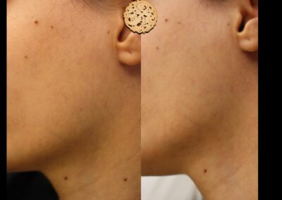 dermaplaning treatment neck area before after | Medical Spa Beverly Hills