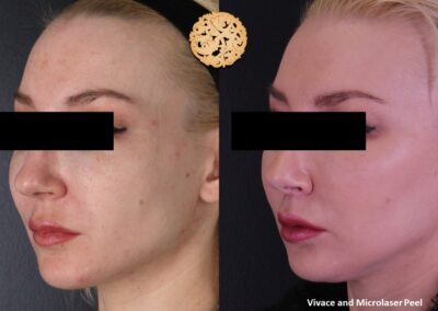Angled profile view of skin refinement from Vivace microneedling and microlaser peel with SPA26.