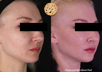Blonde woman profile before and after Vivace microneedling and microlaser peel by SPA26.