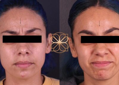 Facial rejuvenation visible in before and after photos, with Botox and fillers providing wrinkle smoothing and volume enhancement