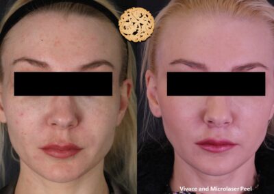 Frontal face view comparing before and after Vivace microneedling and microlaser peel treatment by SPA26.