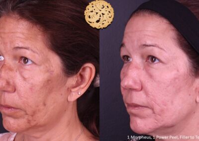 Frontal comparison of a mature woman pre and post microneedling facial therapy with SPA26.