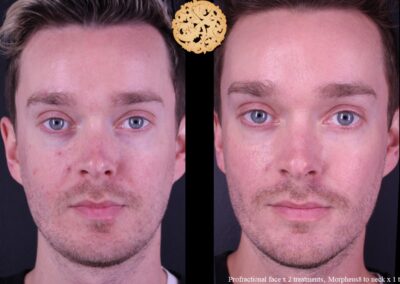 Frontal view of a male showing results before and after microneedling treatment.