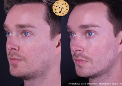 Male face slightly turned with before and after view of microneedling treatments.
