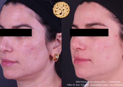 Facial profile before and after microneedling treatment showing skin texture enhancement by SPA26.