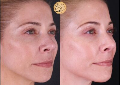 Before and after view of microneedling on female, showing skin rejuvenation and smoother complexion post-treatment.