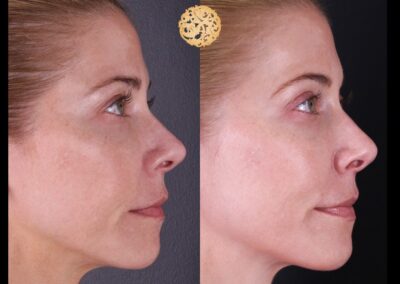 Profile comparison of microneedling effects on woman's skin.