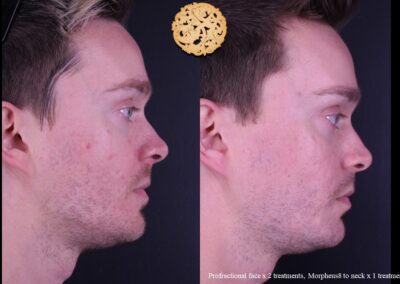 Male profile showing the effects of microneedling treatments on face and neck